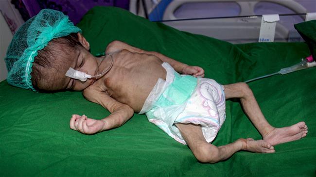 50, 000 children die every year in Yemen: Ansarullah