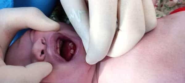  A baby with four Natal Teeth born in Baghlan province