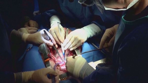  In a first, man gets heart transplant from genetically altered pig 