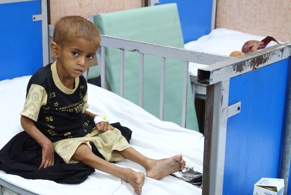  Hospital in Kabul receives 8 malnourished children every day